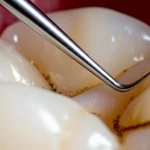 Primo piano macro fotorealistico, scattato con lente da 60mm, di uno strumento odontoiatrico (es. punta di ablatore a ultrasuoni o curette) vicino alla superficie di una radice dentale. Si intravede la texture della dentina e forse qualche traccia di biofilm. L'illuminazione è controllata per creare un'atmosfera clinica ma dettagliata, mettendo in risalto l'interazione tra strumento e dente. High detail, precise focusing.