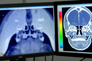 Visualizzazione fotorealistica di un'analisi CBCT della sincondrosi sfeno-occipitale su un monitor ad alta risoluzione, con sovrapposta un'interfaccia del software ImageJ che mostra l'istogramma e la pseudocolorazione 'Spectrum' dai colori vivaci, obiettivo macro 85mm, alta definizione, illuminazione controllata focalizzata sullo schermo in un ambiente di ricerca moderno.