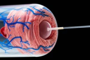 Fotografia macro con lente da 100mm di un palloncino medicato (DCB) parzialmente gonfiato all'interno di un modello trasparente di arteria femoropopliteale che mostra una lunga lesione aterosclerotica. Illuminazione controllata da studio, alta definizione dei dettagli del catetere e della placca, focus preciso sul palloncino.