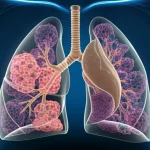 Illustrazione medica fotorealistica di polmoni umani affetti da ARDS con aree evidenti di fibrosi polmonare, visualizzazione interna dettagliata con alveoli danneggiati e tessuto cicatriziale fibroso, illuminazione drammatica da studio, obiettivo macro 100mm, alta definizione.
