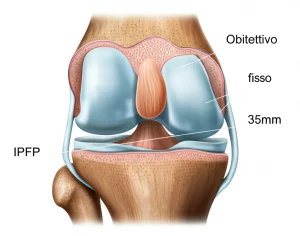 Obiettivo fisso, 35mm, profondità di campo, che mostra un'illustrazione medica ravvicinata e leggermente stilizzata di una sezione trasversale dell'articolazione del ginocchio, evidenziando il corpo adiposo infrapatellare (IPFP) con un colore distinto, suggerendone l'importanza nella prognosi dell'artrosi.