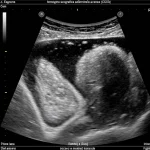 Immagine ecografica addominale avanzata (CEUS) che evidenzia una lesione epatica complessa accanto a una massa appendicolare, illustrando la diagnosi differenziale tra ascesso e metastasi tumorale. Prime lens, 35mm, depth of field, controlled lighting.