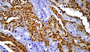 Vista macro al microscopio di cellule tumorali pancreatiche NEN colorate con immunoistochimica per il recettore GLP-1R (colorazione marrone sulla membrana), illuminazione controllata, obiettivo macro 100mm, alta definizione dei dettagli della membrana cellulare e dei nuclei (blu/viola), sfondo leggermente sfocato (profondità di campo).