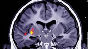 Visualizzazione medica fotorealistica del cervello umano in sezione trasversale, con il plesso coroideo evidenziato in colore brillante all'interno dei ventricoli e aree di iperintensità della sostanza bianca visibili. Obiettivo prime 35mm, profondità di campo ridotta per focalizzare l'attenzione sulle strutture chiave, illuminazione drammatica stile "film noir" per accentuare i dettagli.