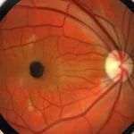 Close-up, immagine fotorealistica del fondo di un occhio umano ripreso con un obiettivo grandangolare (20mm), che mostra la retina periferica con una lesione biancastra distinta, leggermente elevata, indicativa di PEHCR. Messa a fuoco nitida, illuminazione da ambiente clinico. Rappresenta la sfida della diagnosi delle condizioni oculari periferiche.