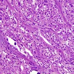Immagine al microscopio ad alta potenza che mostra cellule tumorali prostatiche miste, alcune di aspetto ghiandolare (adenocarcinoma) e altre allungate, fusiformi (componente sarcomatoide), con nuclei atipici. Illuminazione controllata per evidenziare i dettagli cellulari, lente macro 100mm, alta definizione.