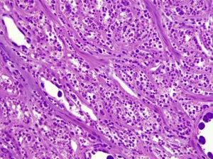 Immagine al microscopio ad alta potenza che mostra cellule tumorali prostatiche miste, alcune di aspetto ghiandolare (adenocarcinoma) e altre allungate, fusiformi (componente sarcomatoide), con nuclei atipici. Illuminazione controllata per evidenziare i dettagli cellulari, lente macro 100mm, alta definizione.