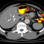 Immagine fotorealistica di una scansione PET/CT addominale che evidenzia metastasi peritoneali con colori brillanti (giallo/arancio/rosso) su sfondo anatomico scuro derivante dalla CT. Obiettivo macro 100mm, alta definizione, illuminazione controllata per massimizzare il contrasto tra tessuto sano e aree metabolicamente attive, rappresentando la capacità diagnostica della tecnica.