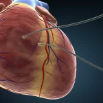 Visualizzazione 3D fotorealistica di un cuore umano affetto da cardiomiopatia ipertrofica, con il setto interventricolare marcatamente ispessito. Un catetere sottile è visibile mentre entra in un ramo settale per eseguire un'ablazione alcolica. Illuminazione drammatica che evidenzia la struttura cardiaca, obiettivo macro 100mm, dettagli anatomici precisi, sfondo scuro.