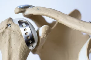 Fotografia macro, 85mm lens, di un modello anatomico di clavicola umana che mostra affiancati i due metodi di fissazione: un chiodo endomidollare inserito nel canale e un sistema di doppia placca a basso profilo avvitato sulla superficie. Illuminazione controllata da studio, alta definizione, focus preciso sugli impianti metallici e sulla texture dell'osso.