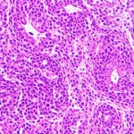 Immagine microscopica ad alta risoluzione di tessuto sinoviale infiammato da artrite reumatoide, con evidenza di iperplasia delle cellule FLS e infiltrazione di cellule immunitarie. Illuminazione da laboratorio, obiettivo macro 60mm, alta definizione dei dettagli tissutali, colori realistici.