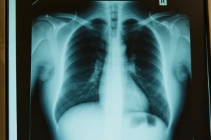 Primo piano di una radiografia toracica che mostra segni evidenti di tubercolosi polmonare complicata, illuminata su un diafanoscopio in un ambiente clinico scuro, alta definizione, illuminazione controllata focalizzata sulla lastra, obiettivo macro 60mm.