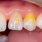 Close-up Macro Shot, lente da 85 mm, del primo molare di un bambino che mostra opazioni distinte di ipomineralizzazione giallo cremoso in contrasto contro lo smalto bianco sano, alto dettaglio, illuminazione dentale controllata