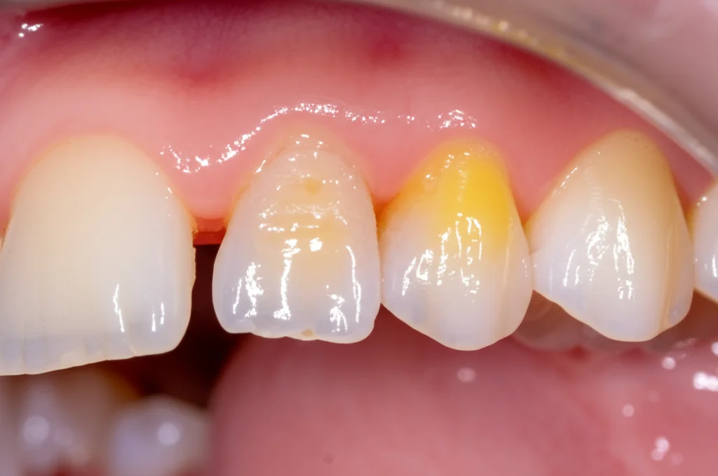 Close-up Macro Shot, lente da 85 mm, del primo molare di un bambino che mostra opazioni distinte di ipomineralizzazione giallo cremoso in contrasto contro lo smalto bianco sano, alto dettaglio, illuminazione dentale controllata