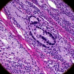 Immagine al microscopio elettronico di cellule di sarcoma dei tessuti molli, con dettagli ad alta definizione delle strutture cellulari anomale, illuminazione controllata per evidenziare le texture, lente macro 100mm, focus preciso.