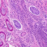 Immagine macro di una sezione di tessuto renale al microscopio, con aree normali e aree con cellule tumorali PNET visibili. Illuminazione da laboratorio precisa, obiettivo macro 90mm, alta definizione, colori vividi ma realistici.