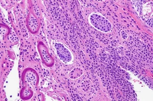 Immagine macro di una sezione di tessuto renale al microscopio, con aree normali e aree con cellule tumorali PNET visibili. Illuminazione da laboratorio precisa, obiettivo macro 90mm, alta definizione, colori vividi ma realistici.