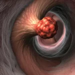 Visualizzazione medica 3D fotorealistica dell'esofago affetto da carcinoma squamocellulare, con evidenza del tumore primario e dei linfonodi coinvolti. Illuminazione drammatica controllata, obiettivo macro virtuale 80mm per dettagli elevati, texture realistiche dei tessuti.