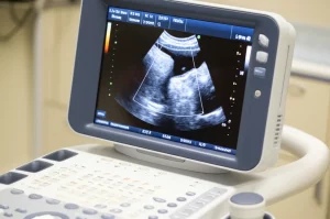 Primo piano di un esame ecografico addominale focalizzato sullo stomaco di un paziente, con lo schermo dell'ecografo visibile che mostra misurazioni in tempo reale della motilità gastrica. Obiettivo prime 50mm, profondità di campo, illuminazione controllata per un aspetto clinico realistico e professionale.