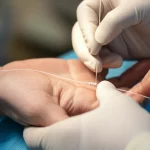 Primo piano sulla mano e polso di un paziente dove un medico sta eseguendo un accesso radiale distale (dTRA) nella tabacchiera anatomica per una procedura di stenting carotideo. Si intravede il catetere sottile. Obiettivo macro 70mm, alta definizione, illuminazione da studio controllata, focus preciso sul punto di inserzione.