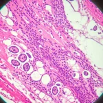 Vista microscopica di tessuto polmonare umano che mostra cicatrici fibrotiche, lente macro, 100mm, alto dettaglio, messa a fuoco precisa, illuminazione controllata, rappresentante la ricerca sulla fibrosi polmonare idiopatica.