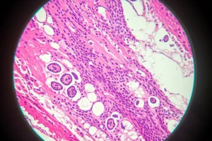 Vista microscopica di tessuto polmonare umano che mostra cicatrici fibrotiche, lente macro, 100mm, alto dettaglio, messa a fuoco precisa, illuminazione controllata, rappresentante la ricerca sulla fibrosi polmonare idiopatica.