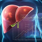 Visualizzazione artistica del fegato umano con evidenziate aree di infiammazione e crescita tumorale, sovrapposta a grafici di dati scientifici (nomogramma), stile fotorealistico con illuminazione drammatica, lente 50mm.