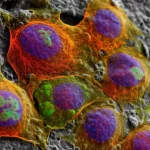 Immagine fotorealistica al microscopio di cellule di carcinoma squamoso della testa e del collo (HNSCC) che mostrano marcatori di resistenza al cisplatino (es. proteine CCNE2 o MNAT1 evidenziate con fluorescenza), obiettivo macro 105mm, alta definizione, illuminazione laterale drammatica per evidenziare la struttura cellulare tridimensionale, focus selettivo su un gruppo di cellule resistenti.
