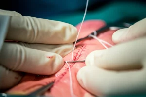 Fotografia realistica di mani guantate di un chirurgo che esegue una sutura continua 'lontano-vicino-vicino-lontano' (Modified Smead-Jones) su un modello anatomico di parete addominale, focus selettivo sulla sutura e sull'ago curvo, illuminazione intensa da sala operatoria, lente macro 90mm, alta definizione dei dettagli del filo e del tessuto simulato.