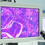 Microscopio digitale avanzato in un laboratorio di patologia moderno, con uno schermo ad alta risoluzione che mostra un'immagine digitale di un vetrino di tessuto mammario colorato con Ematossilina ed Eosina (HeE), evidenziando le cellule tumorali con diversi gradi di atipia nucleare e strutture tubulari. Luce controllata e brillante, alta definizione dei dettagli cellulari, obiettivo macro 100mm per una vista dettagliata.