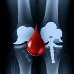 Immagine concettuale che mostra due ginocchia radiografiche sovrapposte a una goccia di sangue stilizzata, una con segni di grave artrosi e l'altra con una protesi impiantata, illuminazione drammatica, stile duotone blu e grigio, lente prime 35mm, a simboleggiare la sfida della chirurgia ortopedica nei disturbi emorragici e il successo dell'intervento di protesi totale di ginocchio.