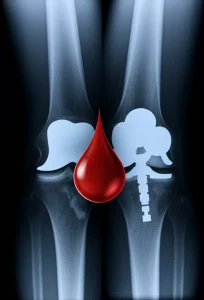 Immagine concettuale che mostra due ginocchia radiografiche sovrapposte a una goccia di sangue stilizzata, una con segni di grave artrosi e l'altra con una protesi impiantata, illuminazione drammatica, stile duotone blu e grigio, lente prime 35mm, a simboleggiare la sfida della chirurgia ortopedica nei disturbi emorragici e il successo dell'intervento di protesi totale di ginocchio.