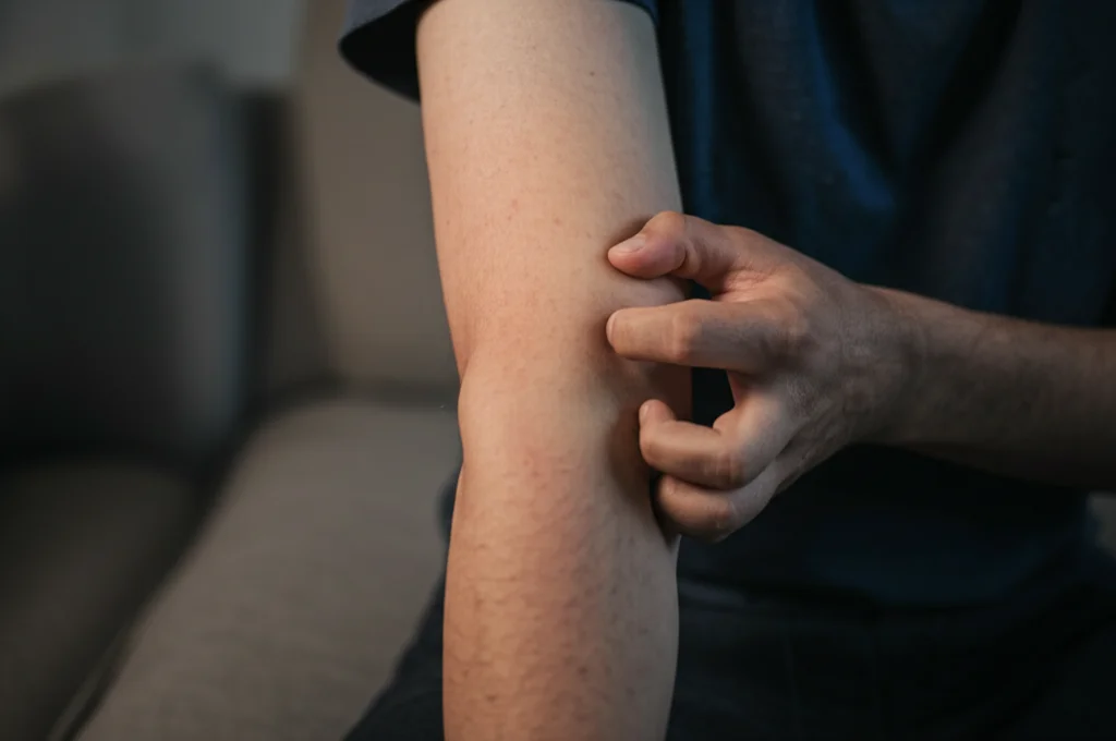 Una persona adulta si gratta il braccio affetto da dermatite atopica, con sfondo sfocato che suggerisce altre preoccupazioni per la salute. 35mm portrait, depth of field, luce naturale soffusa.