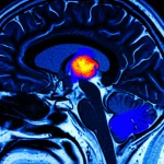 Immagine concettuale fotorealistica che mostra una rete neurale avanzata (DSIT-UNet) che analizza una scansione MRI FLAIR del cervello, evidenziando con precisione un tumore cerebrale complesso, illuminazione high-tech, obiettivo macro 100mm, alta definizione, focus sui dettagli della segmentazione.
