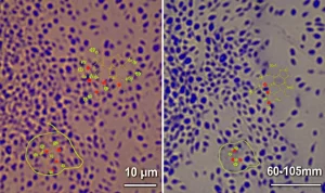 Macro lens, 60-105mm, high detail, controlled lighting, immagine ravvicinata di cellule epiteliali polmonari A549 danneggiate dall'infezione di Streptococcus pneumoniae resistente alla penicillina (PRSP), accanto a cellule protette dalla combinazione ottimizzata CAP (acido clorogenico, amigdalina, puerarina), con molecole stilizzate dei composti che interagiscono con le cellule e i batteri, suggerendo protezione e azione antibatterica.