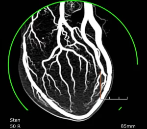 Immagine fotorealistica di un cuore umano con arterie coronarie evidenziate da Angio-TC, mostrando chiaramente sia la stenosi che l'accumulo di placca aterosclerotica lungo le pareti dei vasi, obiettivo macro 85mm, alta definizione, illuminazione da studio medico.