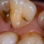 Primo piano fotorealistico, lente macro 100mm, che mostra tessuto gengivale rosa sano integrato perfettamente con la radice di un dente, simboleggiando la rigenerazione parodontale. Alta definizione, illuminazione naturale morbida, profondità di campo ridotta.