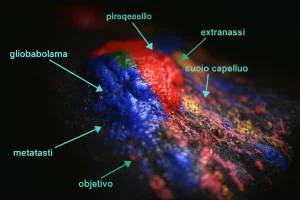 Immagine concettuale del cervello umano con aree evidenziate che mostrano l'attività metabolica alterata del glioblastoma e la rara metastasi extracranica che si estende verso il cuoio capelluto, obiettivo grandangolare 24mm, messa a fuoco nitida sull'interfaccia cervello-metastasi, illuminazione suggestiva che enfatizza la complessità e l'invasività del tumore.