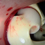 Immagine macro di un'articolazione dell'anca durante un intervento di artroscopia. Si vedono chiaramente la testa del femore e l'acetabolo su un monitor chirurgico. Obiettivo macro 100mm, alta definizione, illuminazione chirurgica precisa, dettagli nitidi della cartilagine.