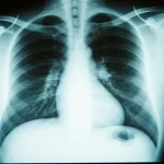 Radiografia del torace che mostra lesioni polmonari cavitarie indicative di tubercolosi avanzata, visualizzata su uno schermo luminoso in una stanza medica buia, focus nitido sulla radiografia, stile documentaristico medico.