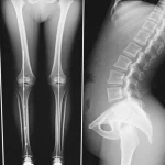 Immagine composita che mostra a sinistra una radiografia a tutta lunghezza degli arti inferiori di un adolescente con linee di misurazione per la LLD, e a destra una radiografia della colonna vertebrale dello stesso paziente che evidenzia una scoliosi funzionale lombare. Concetto medico-diagnostico, alta definizione, illuminazione neutra.
