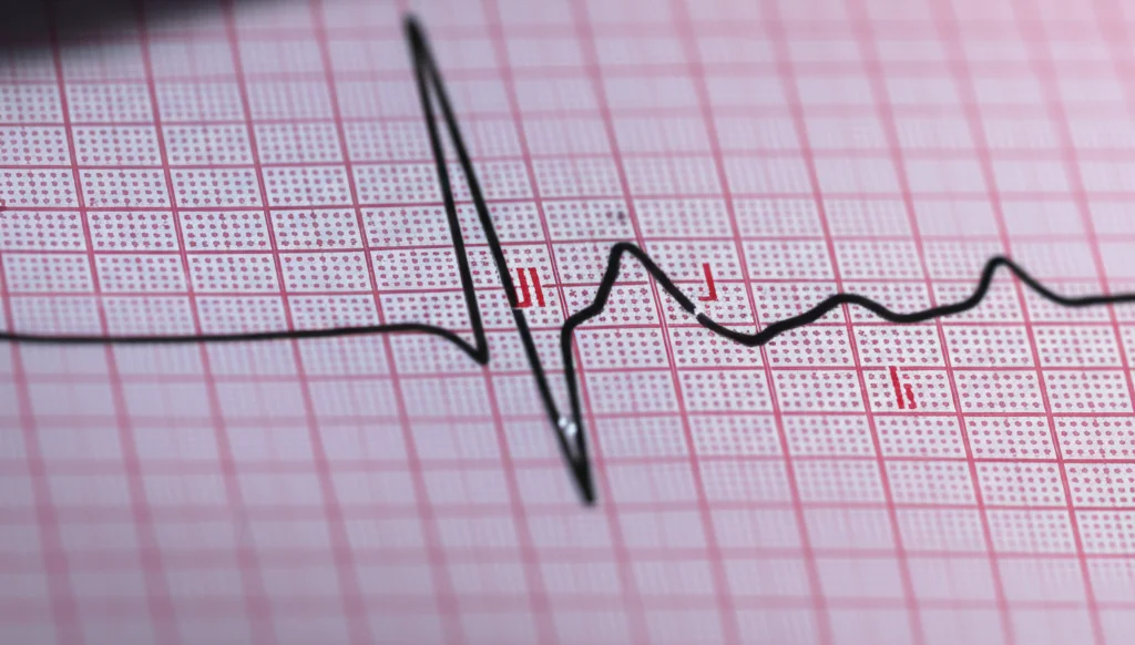 Immagine fotorealistica di un orologio stilizzato sovrapposto a un tracciato ECG con onde J evidenti, simboleggiando la dinamica temporale precoce nell'infarto miocardico acuto, wide-angle, 20mm, sharp focus, luce drammatica.