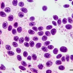 Immagine macro ad alta definizione di cellule tumorali ovariche con pattern neuroendocrino insulare, visualizzate al microscopio con colorazione immunoistochimica positiva per cromogranina, illuminazione controllata, lente macro 100mm, focus preciso sulla marcatura cellulare.