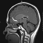 Immagine fotorealistica di una risonanza magnetica cerebrale (MRI) in sezione sagittale che evidenzia le caratteristiche 'dita di Dawson', lesioni iperintense ovoidali perpendicolari al corpo calloso, indicative di sclerosi multipla. Obiettivo prime 35mm, profondità di campo, illuminazione laterale per accentuare i dettagli delle lesioni, sfondo scuro.