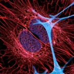Immagine concettuale che fonde una micrografia di cellule di carcinoma mammario micropapillare con pattern astratti di reti neurali digitali luminose. Lente macro 60mm, alto dettaglio, illuminazione controllata per evidenziare sia le strutture cellulari sia le linee digitali, profondità di campo ridotta per creare un effetto artistico ma realistico.