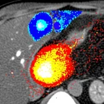 Immagine medica avanzata che mostra una fusione di scansioni PET/MRI del fegato durante una procedura di radioembolizzazione, evidenziando la distribuzione delle microsfere Y-90 nel tumore e nel tessuto sano, wide-angle lens 24mm, sharp focus, high detail, colori vivaci per le mappe di dose.