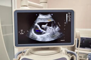 Immagine fotorealistica di un'ecografia dell'antro gastrico visualizzata su un moderno schermo medicale, con sovrapposizioni grafiche generate dall'intelligenza artificiale che evidenziano l'area (CSA) e la curva di motilità in tempo reale, obiettivo macro 80mm, alta definizione, illuminazione soffusa e controllata da sala diagnostica.