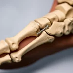 Modello anatomico dettagliato del piede umano che illustra l'intervento chirurgico combinato per il piede piatto: si vedono i segni dell'artroeresi nel seno del tarso e le viti per l'artrodesi navicolo-cuneiforme che stabilizzano l'arco mediale, macro lens 100mm, high detail, precise focusing, controlled lighting, sfondo neutro.