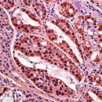 Immagine fotorealistica astratta che rappresenta la struttura della chinasi lipidica PIKfyve sovrapposta a un'immagine microscopica di tessuto di adenocarcinoma duttale pancreatico (PDAC), con dettagli elevati e illuminazione drammatica, obiettivo macro 85mm.
