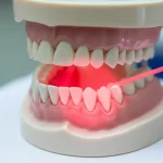 Immagine fotorealistica di un fascio di luce laser rossa (simbolo della PBM) che illumina delicatamente l'area gengivale di una mandibola modello in un contesto clinico pulito e moderno, messa a fuoco selettiva sulla luce, obiettivo macro 60mm, illuminazione controllata ad alto dettaglio.